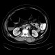 Large bowel ileus: CT - Computed tomography